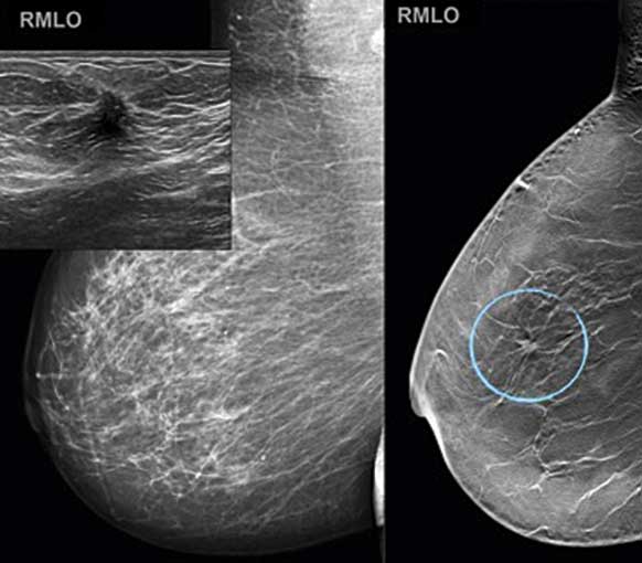 ultraljud mammografi bröst
