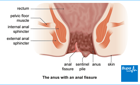 spinkter spasmer anal