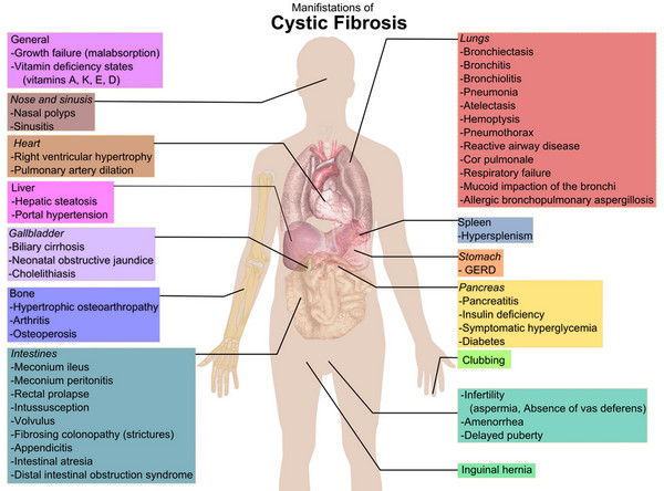 fibros cystisk