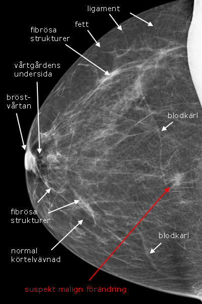 ultraljud mammografi bröst