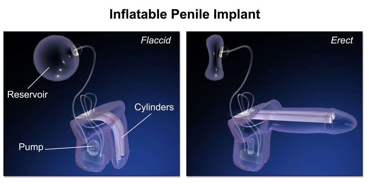 implantat mannlichen penis