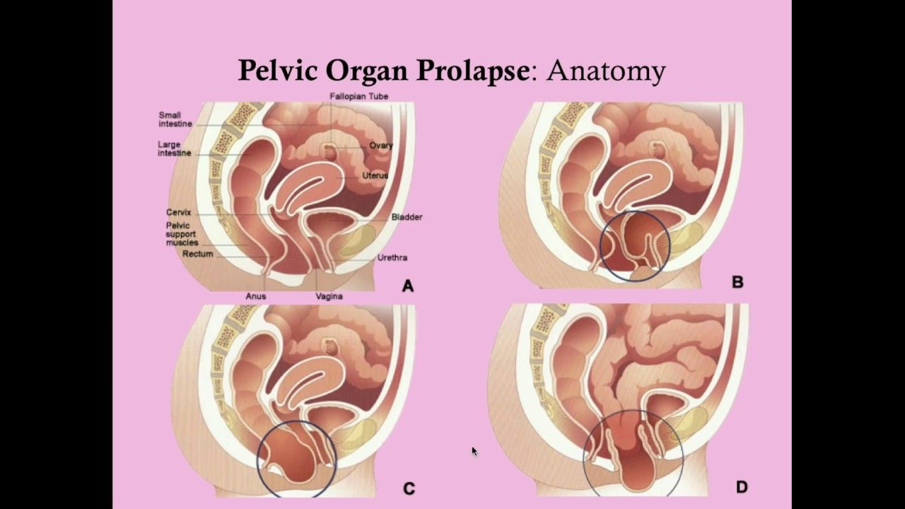 prolaps urinblåsa vaginal